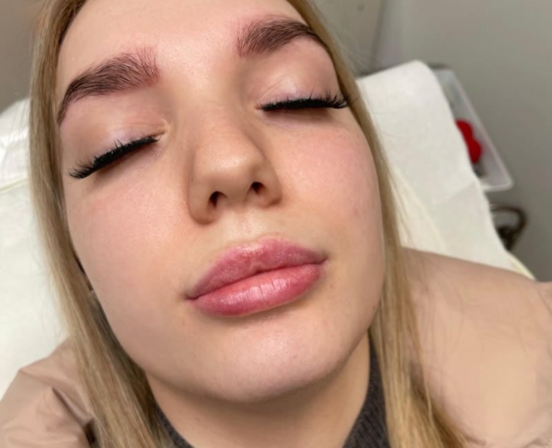 Signature dermal lip filler - before