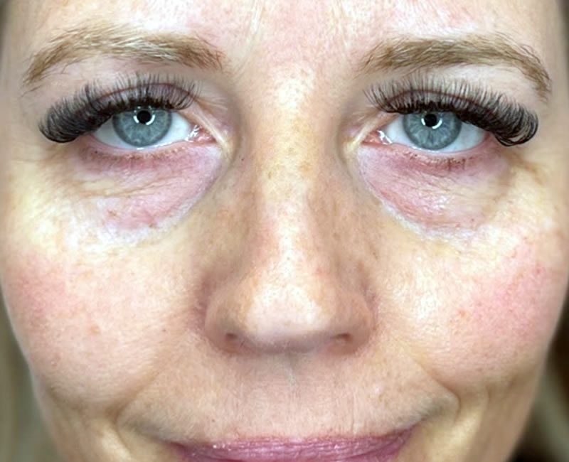 BEFORE Tear trough dermal filler