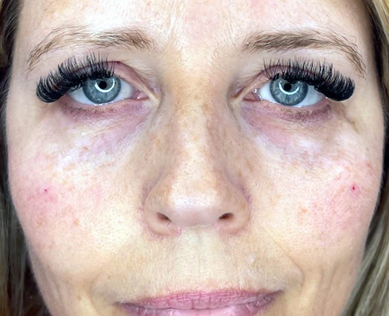 AFTER Tear trough dermal filler