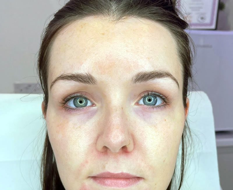 BEFORE Dermal Filler