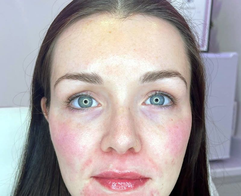AFTER Dermal Filler