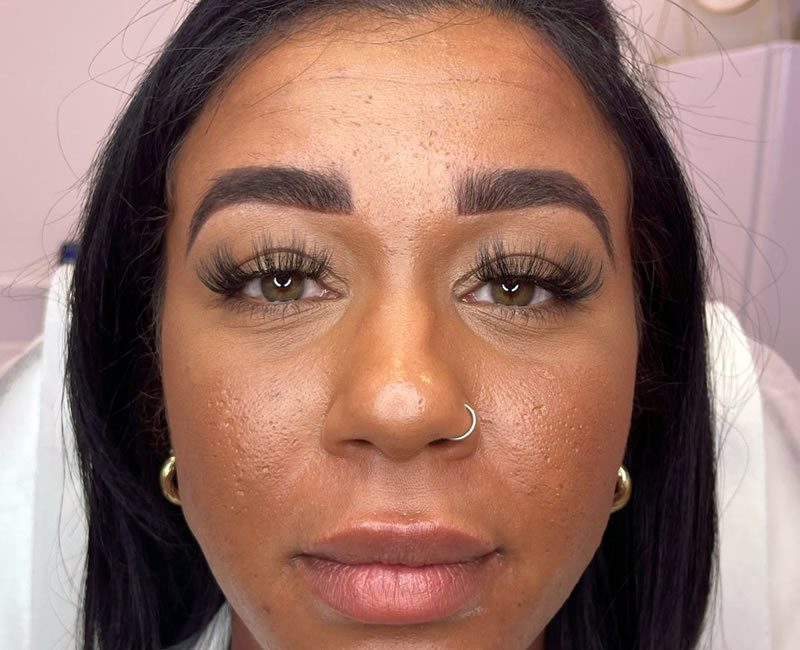 BEFORE Dermal Filler