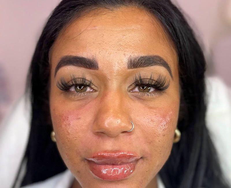 Dermal Filler - after