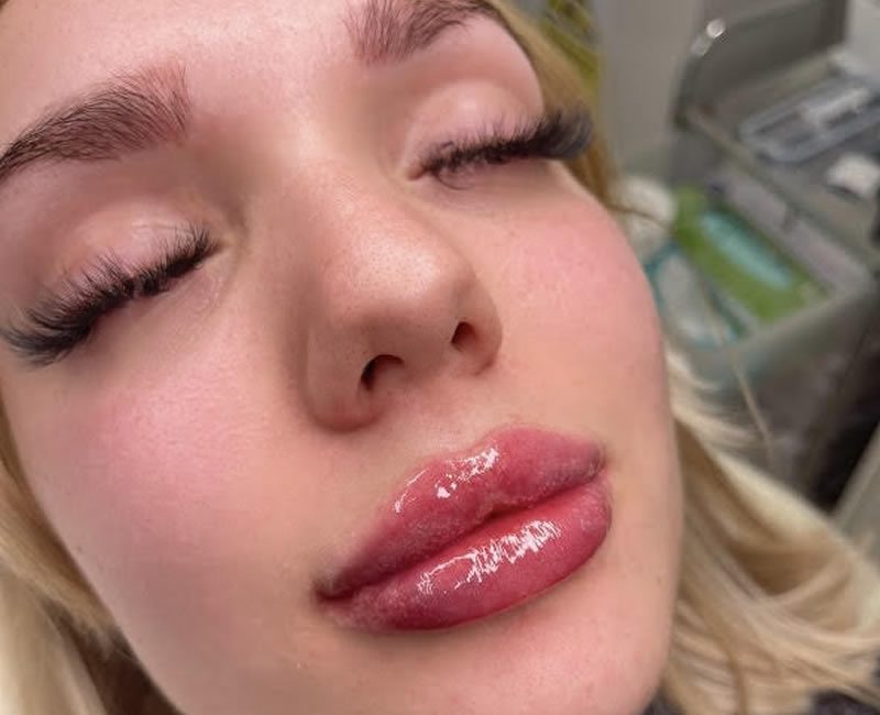 Signature dermal lip filler 1.1ml - after