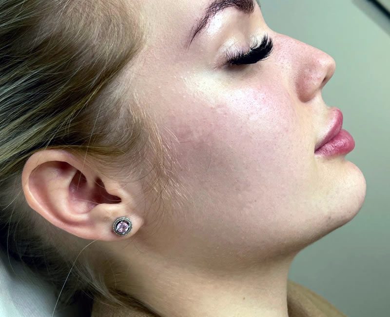 Dermal Jawline filler - before