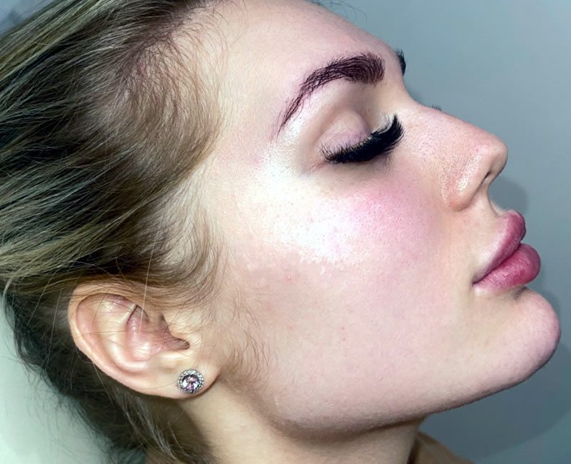 Dermal Jawline filler - after