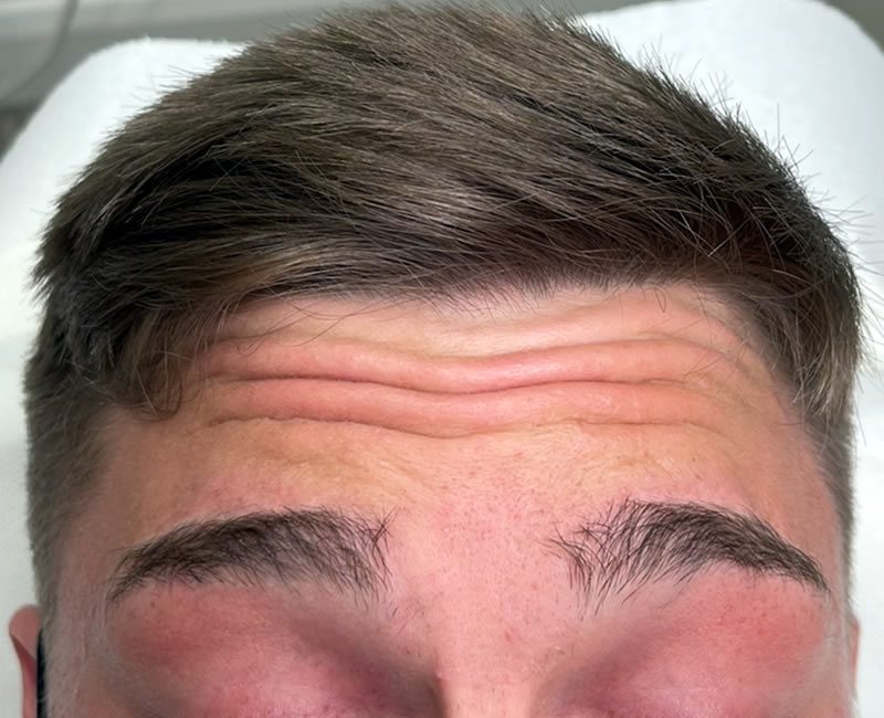 Anti Wrinkle - before