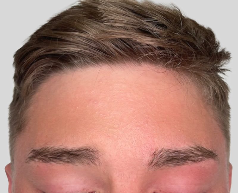 Anti Wrinkle - after