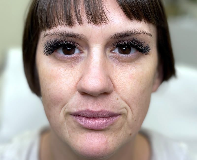 BEFORE Rejuvenation package – cheeks, fibre separation, facial lines