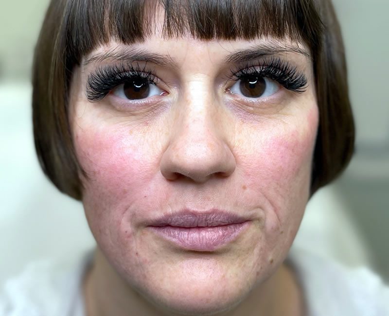 AFTER Rejuvenation package – cheeks, fibre separation, facial lines