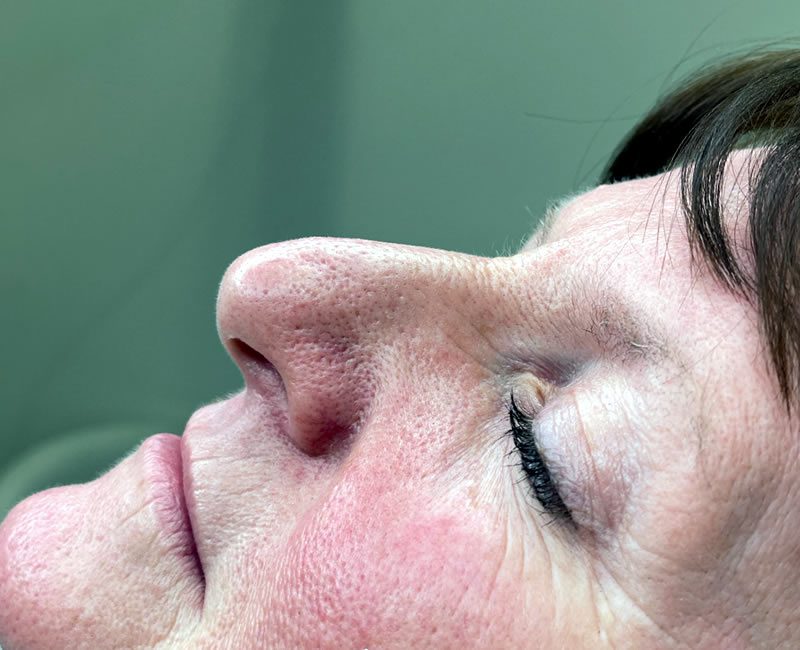 BEFORE Rhinoplasty