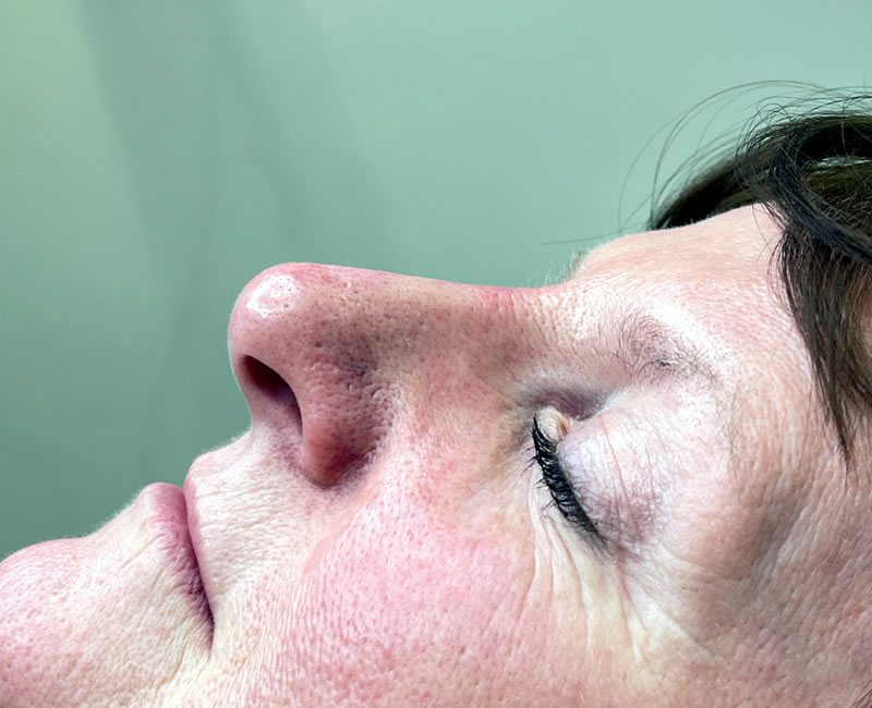 AFTER Rhinoplasty