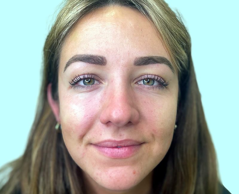 BEFORE Rejuvenation package – lips & cheeks
