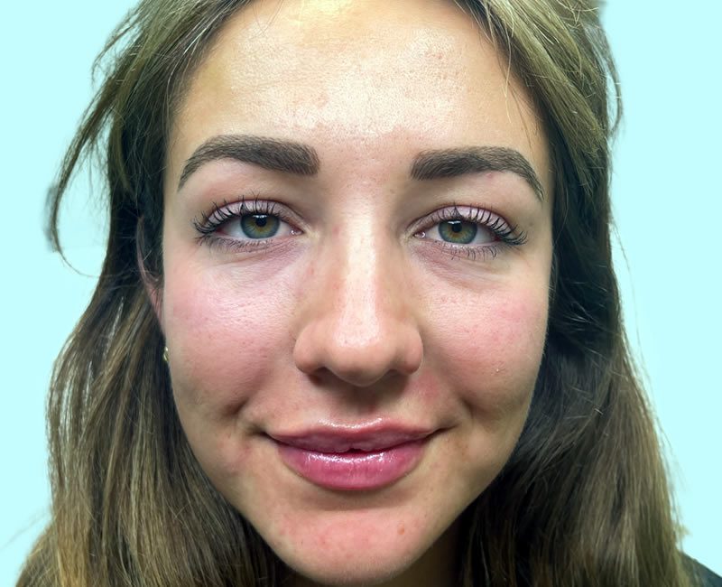 AFTER Rejuvenation package – lips & cheeks