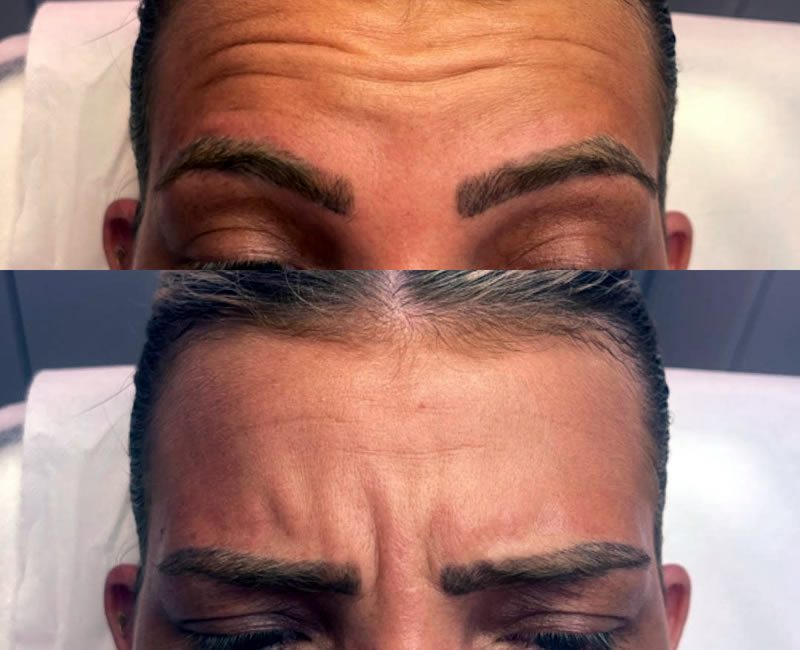 BEFORE Anti Wrinkle