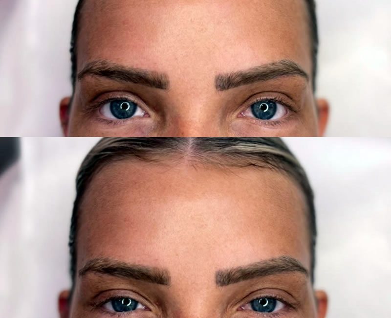 AFTER Anti Wrinkle